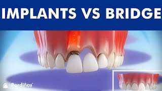 Dental Implants VS Tooth bridge  Comparison © [upl. by Omrellug77]