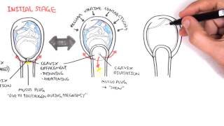 Occiput posterior fetal position [upl. by Adnarram78]