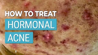 How to Treat Your Hormonal Acne  A Skincare Experts Advice [upl. by Daph]