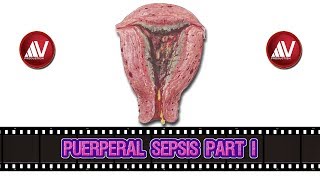 Puerperal Sepsis Part I [upl. by Bobbee]