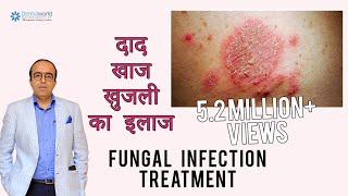 फ़ंगस इनफ़ेक्शन दिनाय दाद खाज का इलाज  Treating Fungal Infection In HINDI  Dr Rohit Batra [upl. by Gombach]