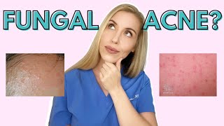 Do YOU have Fungal Acne  Dermatologist Talks Symptoms and Treatments [upl. by Sadie]