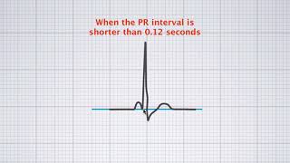 Interpreting ECG duration [upl. by Ahtel]