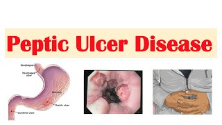 Peptic Ulcer Disease Gastric vs Duodenal Ulcers  Causes Symptoms Diagnosis Treatment [upl. by Budworth]