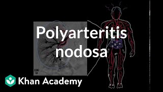 Polyarteritis nodosa  Circulatory System and Disease  NCLEXRN  Khan Academy [upl. by Calore]