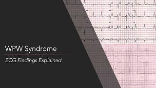 WolffParkinsonWhite WPW Syndrome ECG [upl. by Llenil]