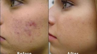 About Microdermabrasion  Before amp After Acne Scars Blackheads PMD Facial routine massage Skincare [upl. by Abshier59]