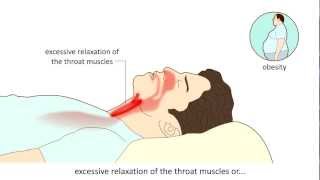 Obstructive Sleep Apnea Syndrome OSAS  Causes and treatment [upl. by Orlando899]