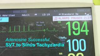 SVT or Supraventricular Tachycardia [upl. by Aneehsor]