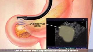 Endoscopic Ultrasound [upl. by Tris266]