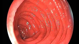 Upper GastroIntestinal UGI Endoscopy  see inside the gut [upl. by Sira]