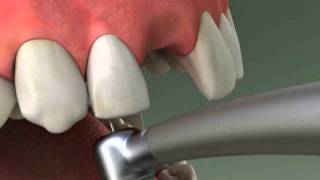 Dentist  Maryland Bridge Procedure [upl. by Eniledam357]