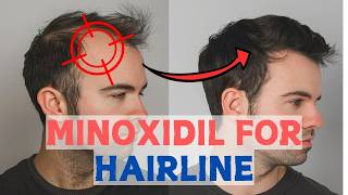 Minoxidil for Frontal Baldness  Restore Your Hairline [upl. by Mahmoud246]