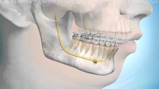 Chirurgie orthognatique ostéotomie mandibulaire [upl. by Niatirb]