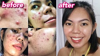 HOW I CLEARED MY ACNE  Cystic Hormonal Acne with PCOS Philippines [upl. by Houser483]