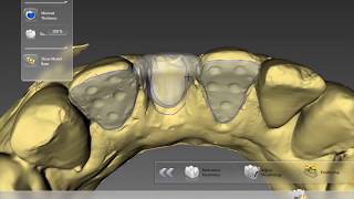 Digital Maryland bridge  Inlab Dentsply Sirona CAD CAM [upl. by Aulea]