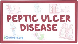 Peptic ulcer disease  causes symptoms diagnosis treatment pathology [upl. by Eeclehc]