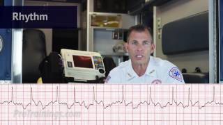 Atrial Fibrillation ECG Rhythm Interpretation [upl. by Delogu635]