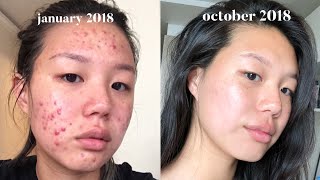 Acne Skincare Routine FINALLY [upl. by Seiber]