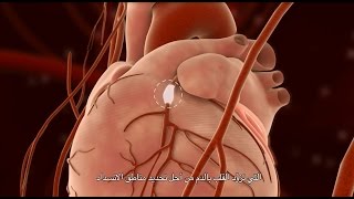 Percutaneous Coronary Intervention PCI [upl. by Sumahs]