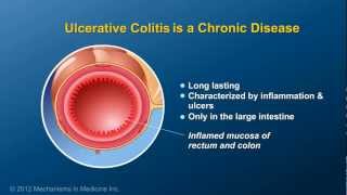 Understanding Ulcerative Colitis  Jumo Health [upl. by Nalrah]