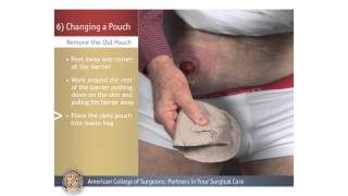 ColostomyIleostomy Changing a Pouch [upl. by Rutra]