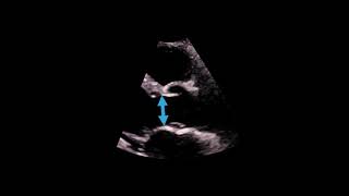 Common Changes in Arterial Line Waveforms [upl. by Mur783]