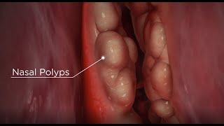 Nasal Polyps diagnosis and treatment options [upl. by Anyrtak]