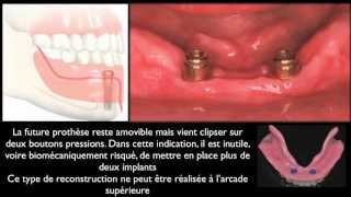 Prothèse amovible et implants dentairesMandibular overdentures [upl. by Kirwin]