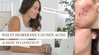 What Hormone Causes Acne PUT AN END TO HORMONAL ACNE [upl. by Cadman607]