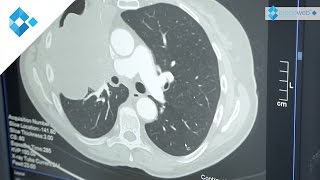 Therapie von Lungenkrebs und NSCLC [upl. by Mafala]