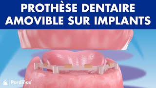 Prothèse dentaire amovible sur implants © [upl. by Yesor]