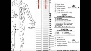 Classifying Spinal Cord Injuries using ASIA Scoring Explanation  Example 1 [upl. by Atikehs99]