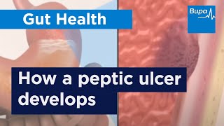 How a peptic ulcer develops  Bupa Health [upl. by Borries]