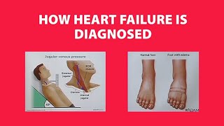 Heart Failure Nurse Certification Review A case study Acute decompensated HFrEF [upl. by Belen]