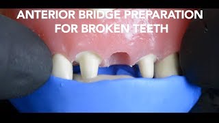 Dental Bridge Preparation after Tooth Extraction [upl. by Ylagam]