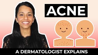 Everything ACNE  What Is Acne What Causes Acne amp Types of Acne [upl. by Adel]