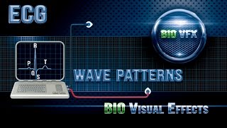 ECG or EKG Wave patterns Part 2 [upl. by Namyl]