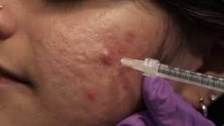 Watch amp Learn Intralesional injections [upl. by Anav]