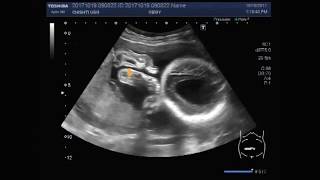 Ultrasound Video showing hydrocephalic fetus [upl. by Tortosa]