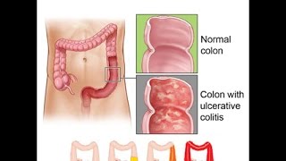 Ulcerative Colitis [upl. by Rosenstein]