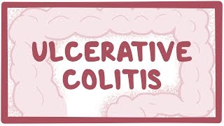 Living with Ulcerative Colitis Patient Stories [upl. by Eidaj]