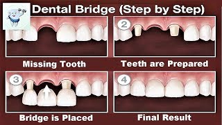 Dental Bridge Procedure Step by Step [upl. by Leigha]