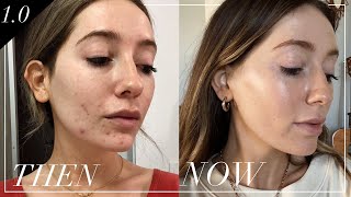 How I cured my hormonal adult acne  skin series [upl. by Chickie773]