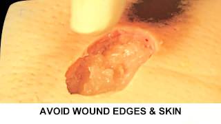 Enzymatic Debridement Demonstration Understand Wound Care [upl. by Cooperman]