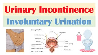 Urinary Incontinence Stress Urge Overflow amp Functional  Causes Symptoms Diagnosis Treatment [upl. by Saltsman]