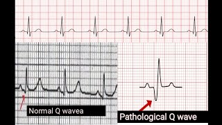 Pathological Q waves in ECG  How to identify pathological Q waves in E CG [upl. by Rafaelle]