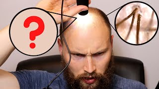 Balding Hair vs quotNormalquot Hair  Miniaturization In Male Pattern Baldness [upl. by Arima]