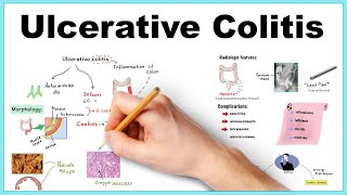 Management of acute severe ulcerative colitis [upl. by Supen]