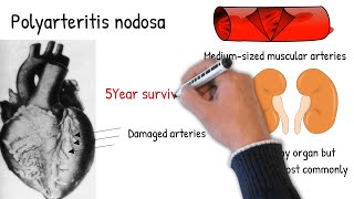 Polyarteritis nodosa made easy [upl. by Clement328]